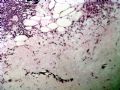 肋骨旁肿瘤STHUIT\final diagnosis 间叶性软骨肉瘤图4