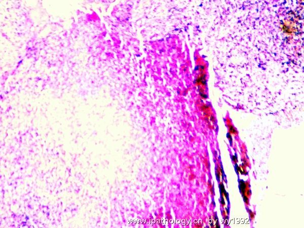 07324tumor hospital鼻腔新生物图1