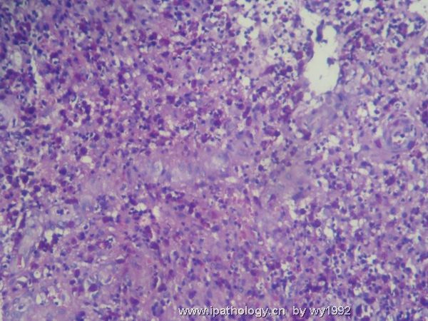 07324tumor hospital鼻腔新生物图3