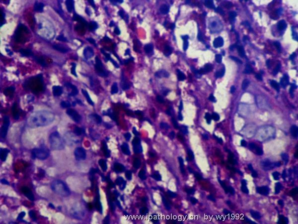07324tumor hospital鼻腔新生物图5