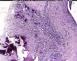 求助：右膝关节骨破坏图18