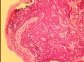 左腭部新生物 08-2025图11