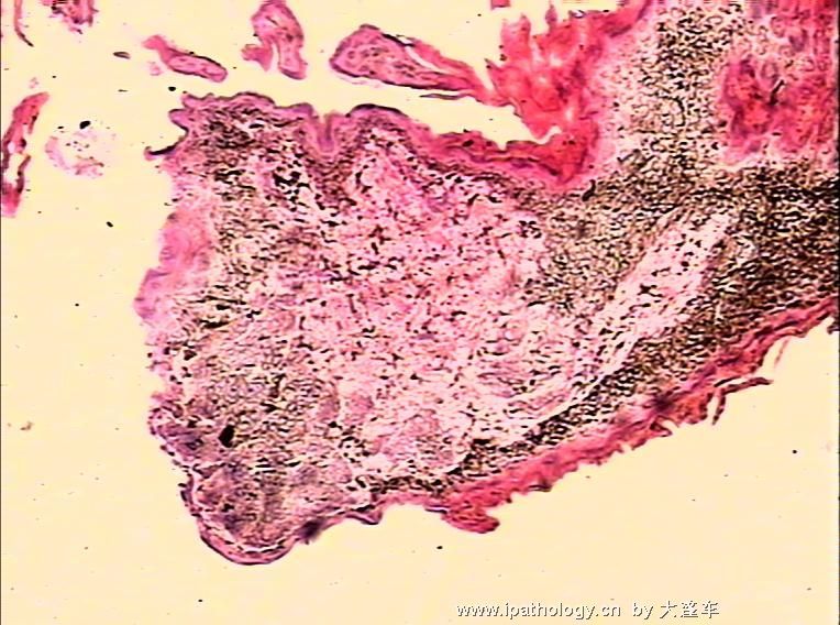 右外耳道新生物 08-2134图6