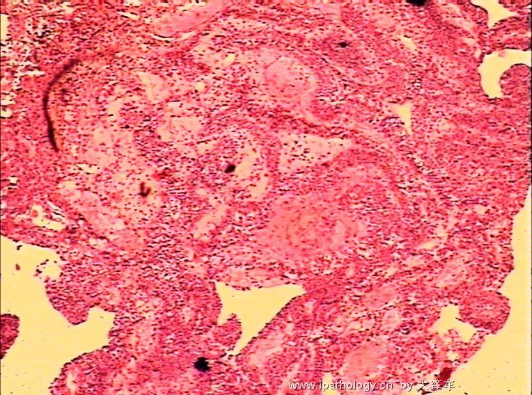 膀胱新生物 08-21354图1
