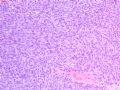 case22-右腹股沟肿物图3