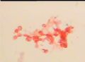 宫颈TCT一例，是纤毛菌吗？图2
