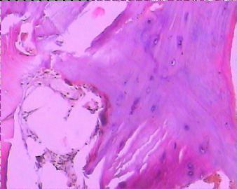 请各位老师看一下这张片子怎么出报告，谢谢！左髂骨骨赘图15