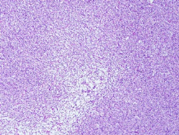 72 year old with a large thigh mass图1