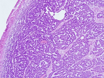 50 year man with right neck mass图1