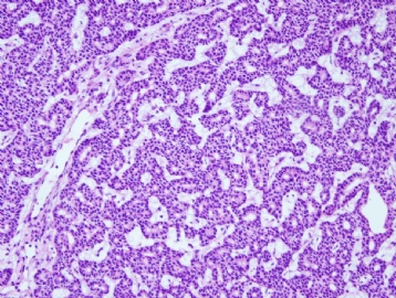 50 year man with right neck mass图2