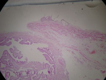 输卵管系膜囊肿，这一类囊肿大家怎么发报告？图3