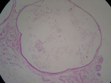 输卵管系膜囊肿，这一类囊肿大家怎么发报告？图4