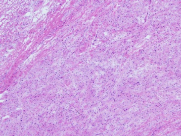 45 year old woman with gastric mass图3