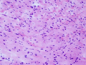 45 year old woman with gastric mass图5