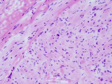 45 year old woman with gastric mass图6