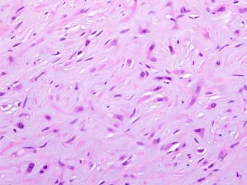 [已确诊]29岁女腹股沟软组织肿物inguinal soft tissue mass-[上皮样血管内皮瘤]图5