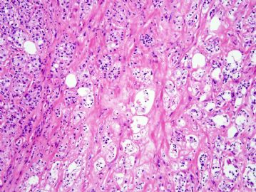 68 year old man with mesenteric nodule图2