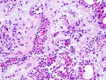 60 year old woman with tracheal mass图3