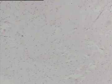 软组织肿物，有点迷茫，请指教！图2