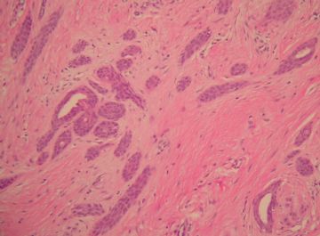 breast lesion图2