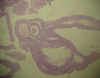 膀胱菜花状肿物一个2cm×1.2cm×0.5cm图1