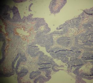 膀胱菜花状肿物一个2cm×1.2cm×0.5cm图9