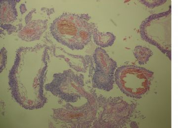 膀胱菜花状肿物一个2cm×1.2cm×0.5cm图17