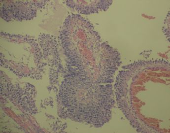 膀胱菜花状肿物一个2cm×1.2cm×0.5cm图18
