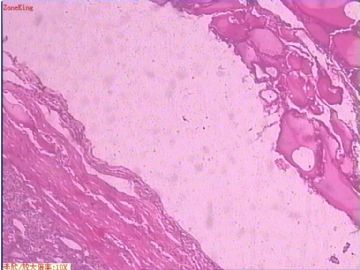 甲状腺 肿物图4