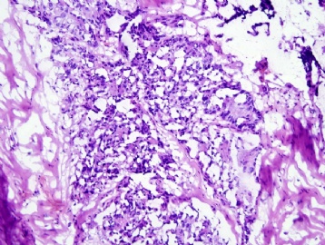 67 year old man with lumbar fracture图2