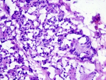 67 year old man with lumbar fracture图3