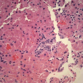 Transplant kidney with elevated creatinin.图1