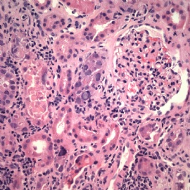 Transplant kidney with elevated creatinin.图2