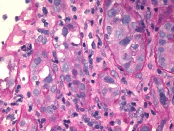 Transplant kidney with elevated creatinin.图3