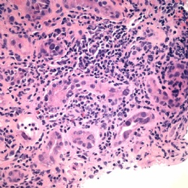 Transplant kidney with elevated creatinin.图4