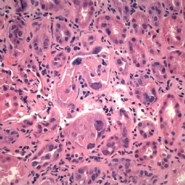 Transplant kidney with elevated creatinin.图5
