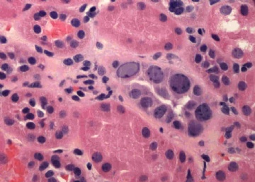 Transplant kidney with elevated creatinin.图6