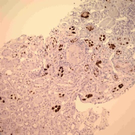 Transplant kidney with elevated creatinin.图7