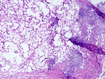 Inflammation or invasive lobular carcinoma图1