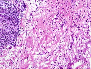 Inflammation or invasive lobular carcinoma图2