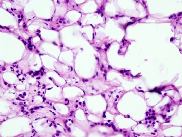 Inflammation or invasive lobular carcinoma图3