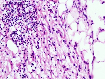 Inflammation or invasive lobular carcinoma图4