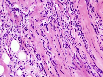 Inflammation or invasive lobular carcinoma图6