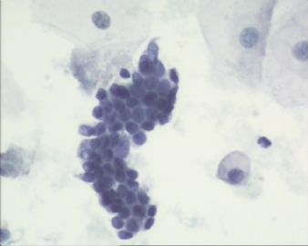 这个有问题吗？42岁 外阴赘生物  腺上皮有问题？图2