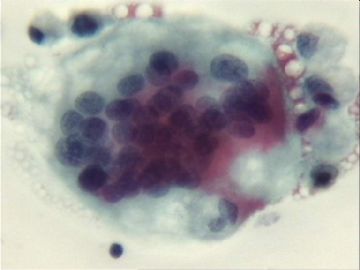 宫颈刮片．７２宫颈赘生物三个有蒂，黄带腥臭一年．图1