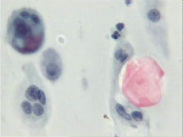 宫颈刮片．７２宫颈赘生物三个有蒂，黄带腥臭一年．图2