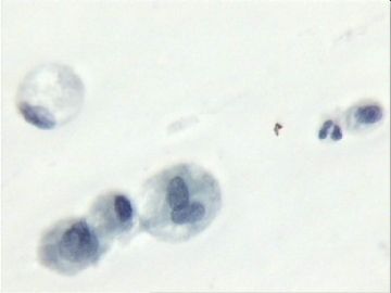 宫颈刮片．７２宫颈赘生物三个有蒂，黄带腥臭一年．图3