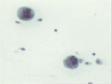 宫颈刮片．７２宫颈赘生物三个有蒂，黄带腥臭一年．图5