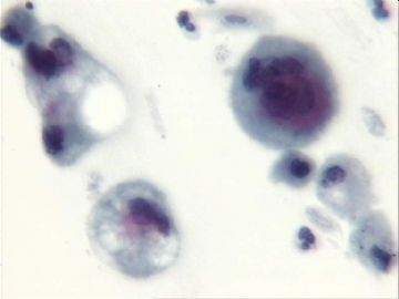 宫颈刮片．７２宫颈赘生物三个有蒂，黄带腥臭一年．图8