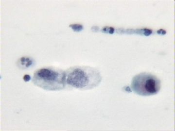 宫颈刮片．７２宫颈赘生物三个有蒂，黄带腥臭一年．图10